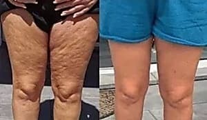 Vorher-Nachher Cellulite-Behandlung